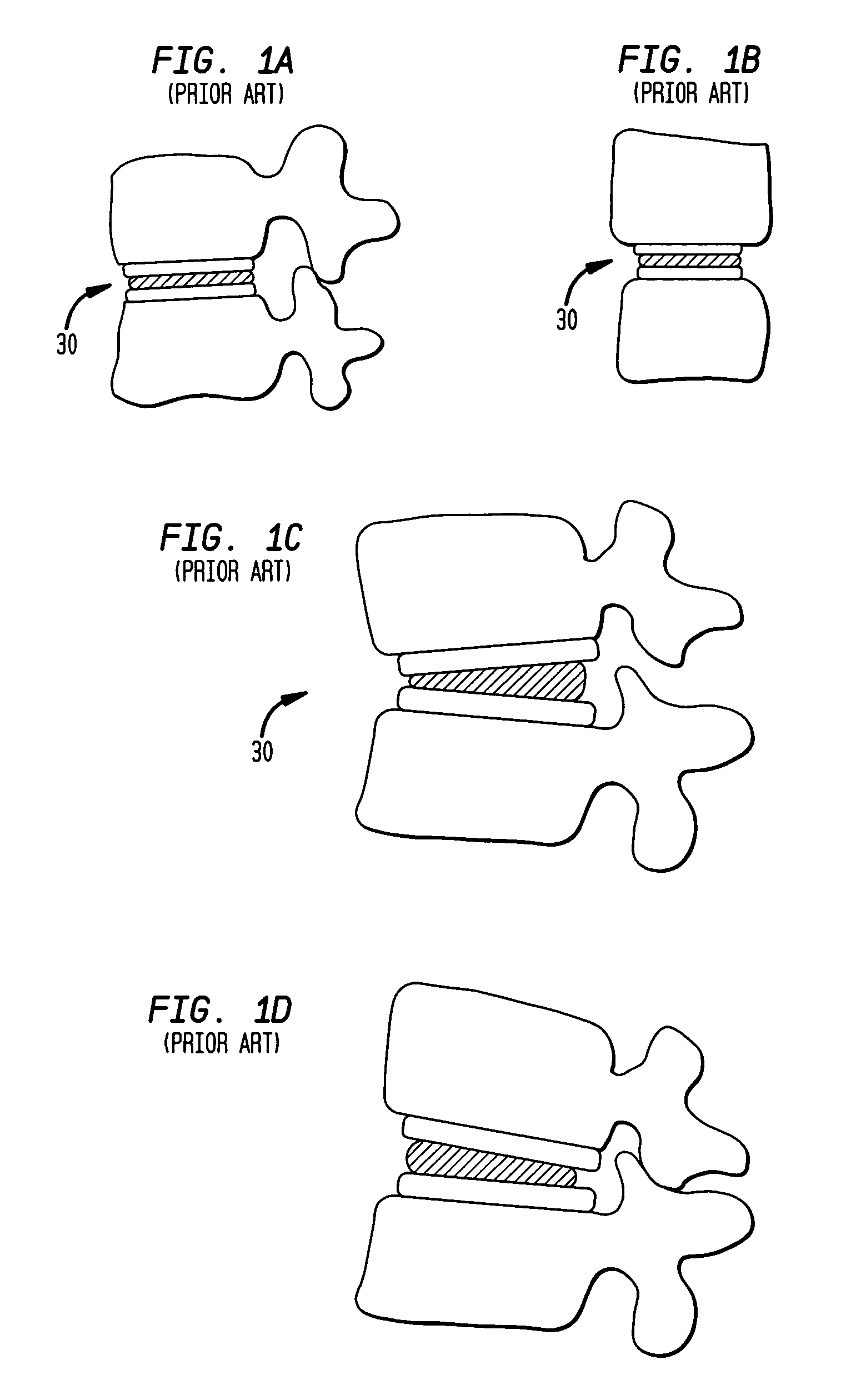 Two-component artificial disc replacements