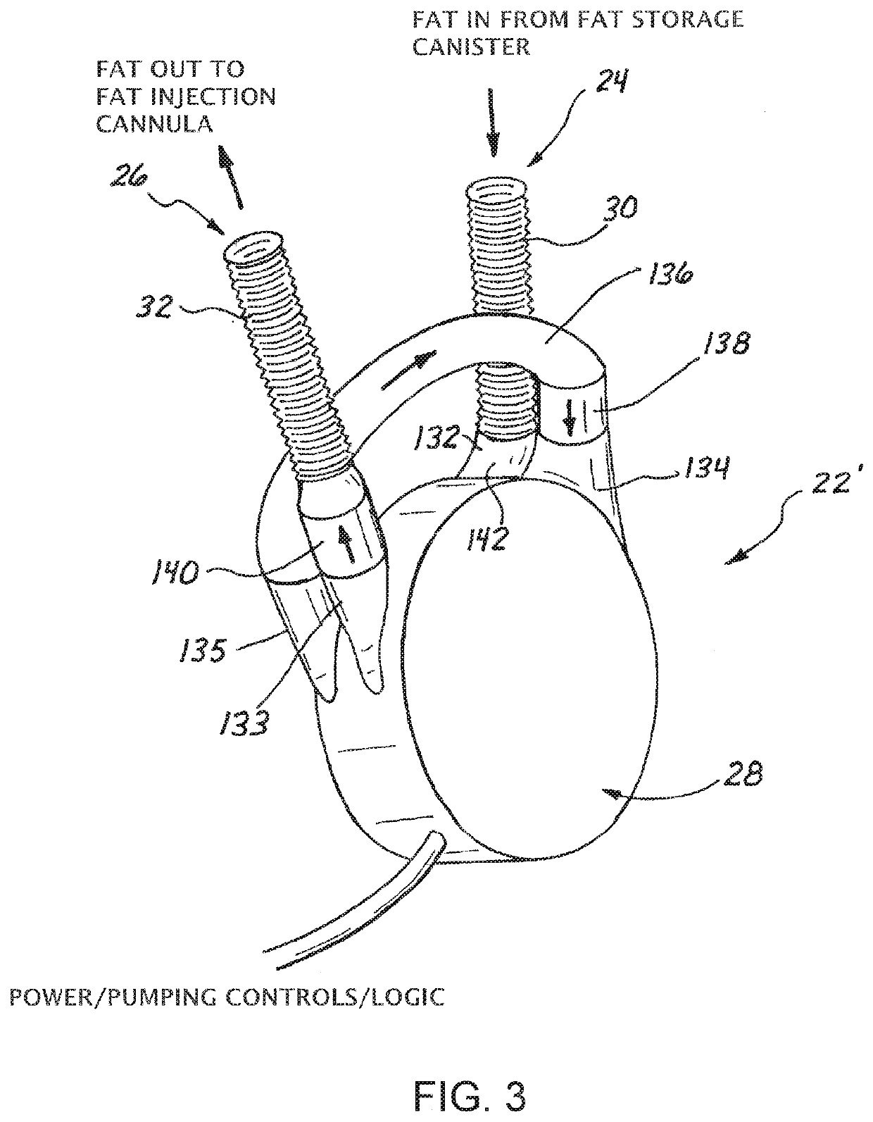 A system for the harvest and transfer for high volume fat grafting using a centrifugal pump