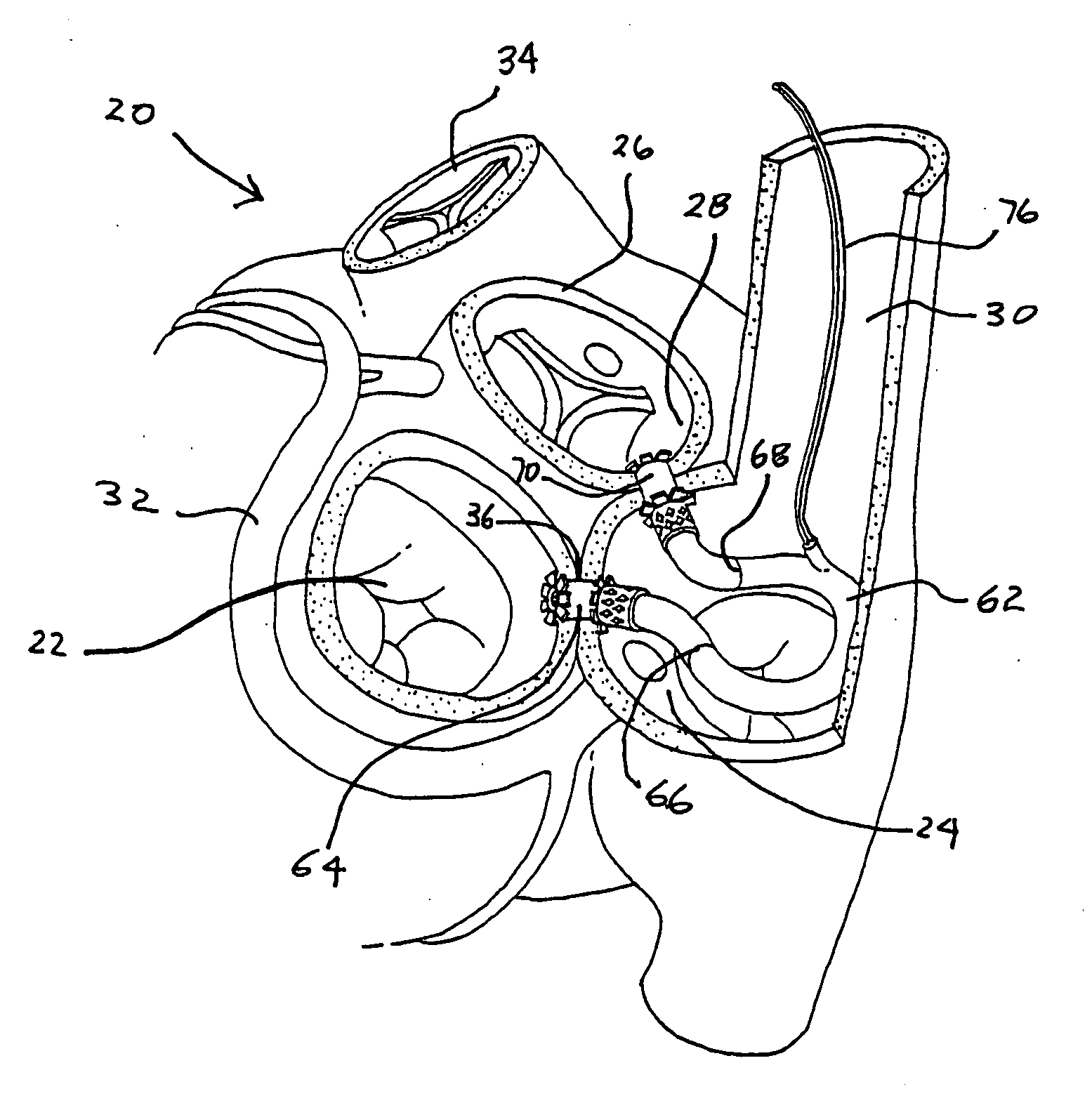 Left ventricular function assist system and method