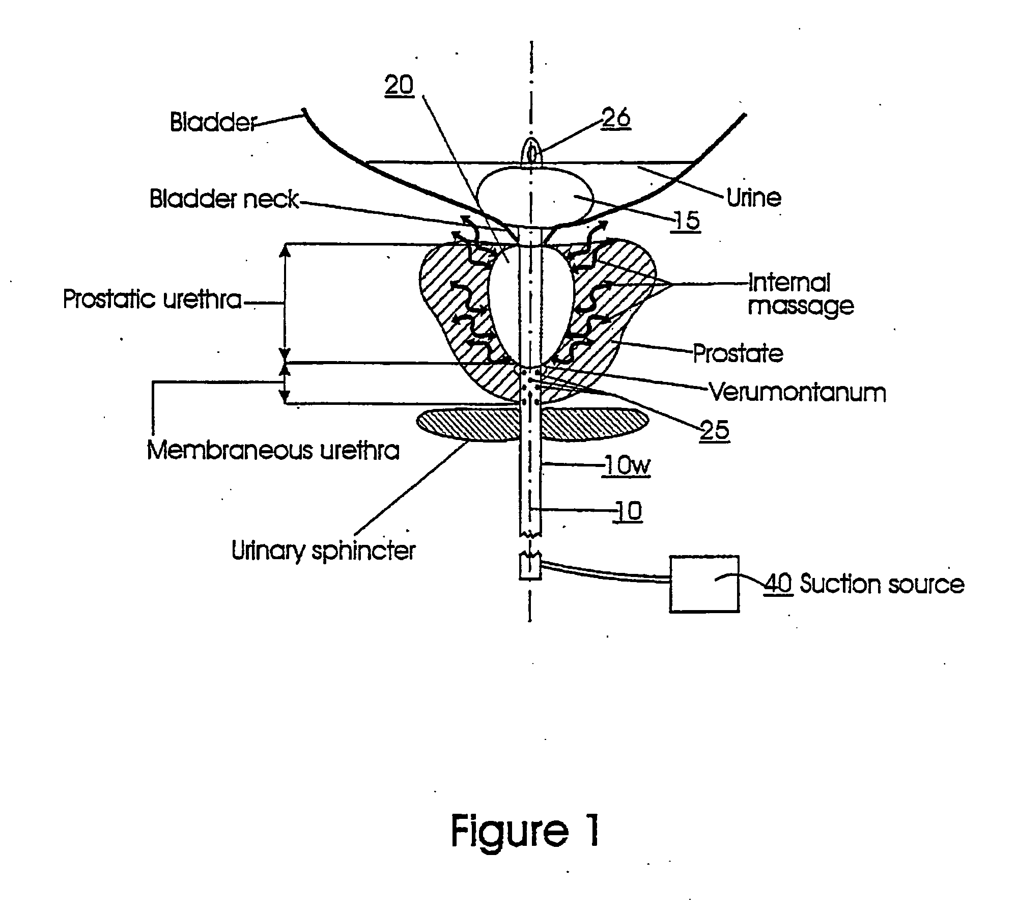 Catheters with suction capability and related methods and systems for obtaining biosamples in vivo