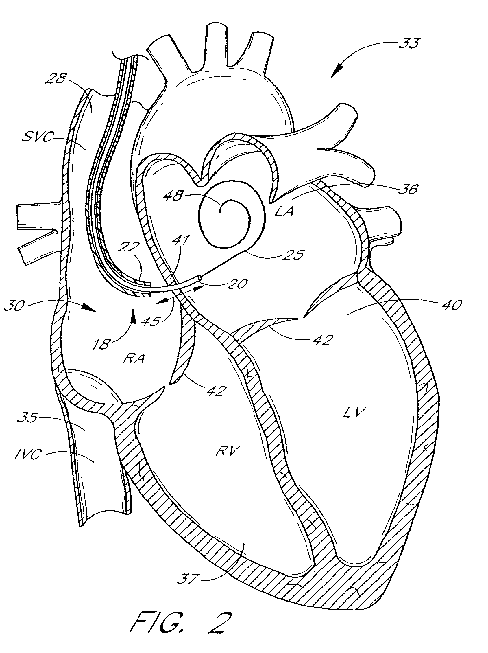 Systems and methods for detecting, diagnosing and treating congestive heart failure