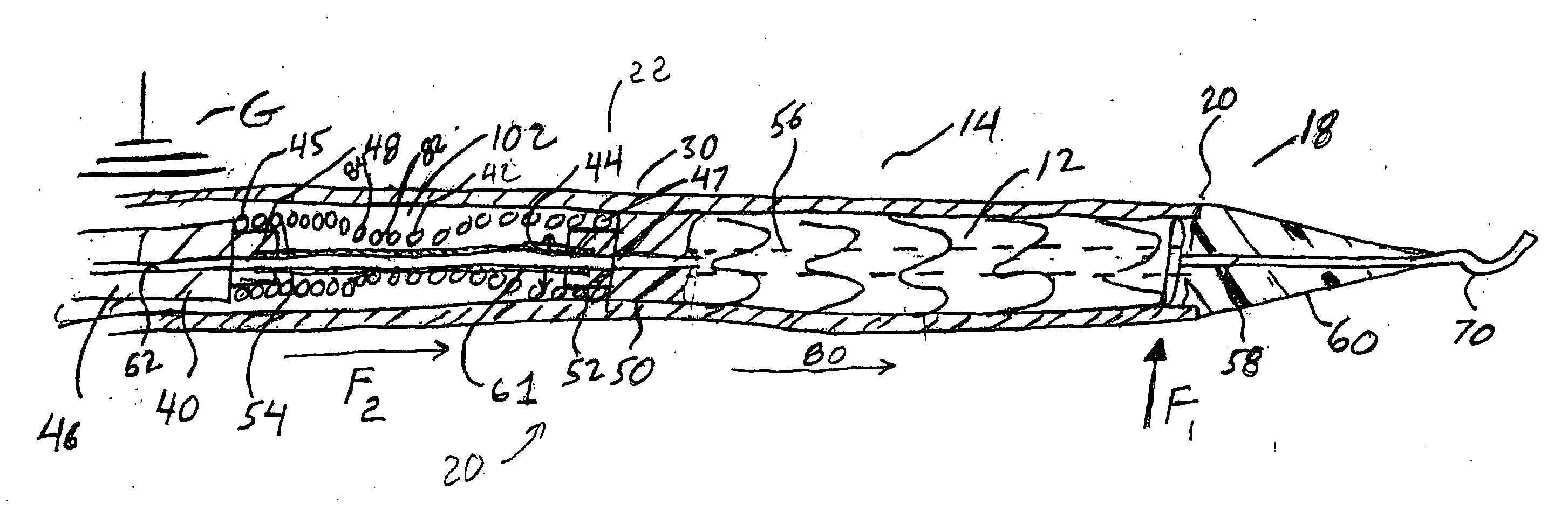 Intravascular deployment device with improved deployment capability