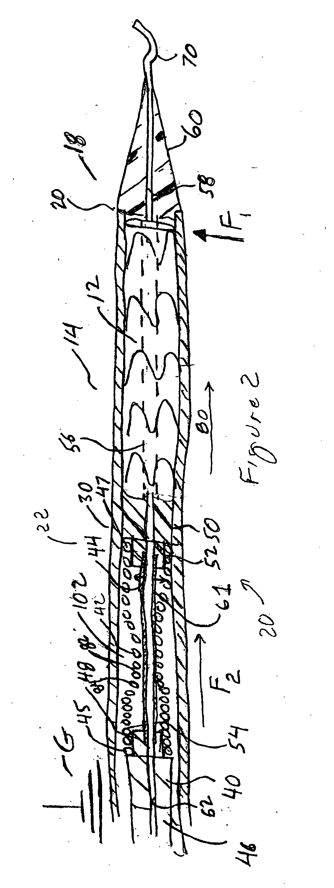 Intravascular deployment device with improved deployment capability