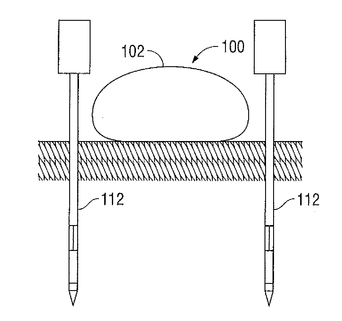 Management of Voltage Standing Wave Ratio at Skin Surface During Microwave Ablation