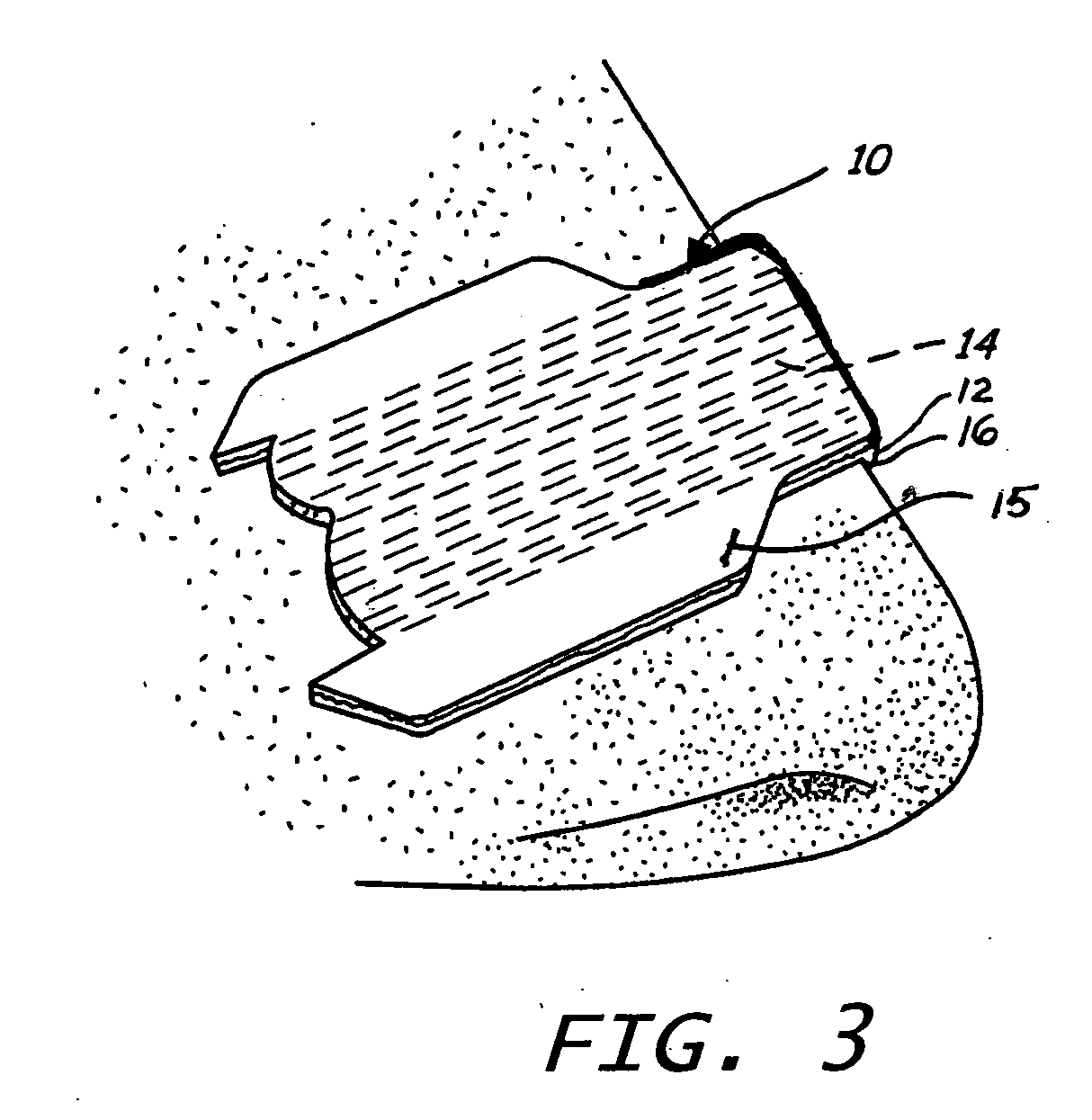 Multiple filament nasal strip with high peel angle release