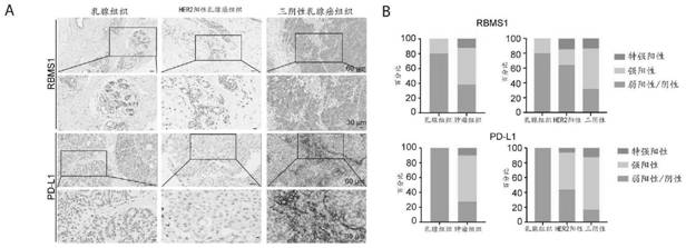 Application of RBMS1 knocking-down reagent in preparation of medicine for treating triple negative breast cancer