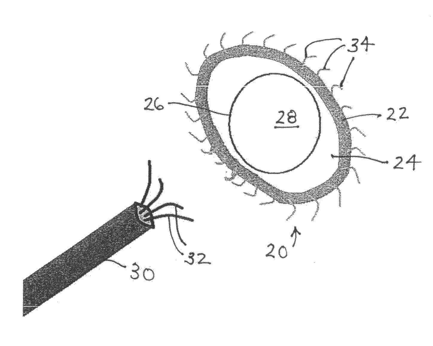 Implantable scaffolding containing an orifice for use with a prosthetic or bio-prosthetic valve