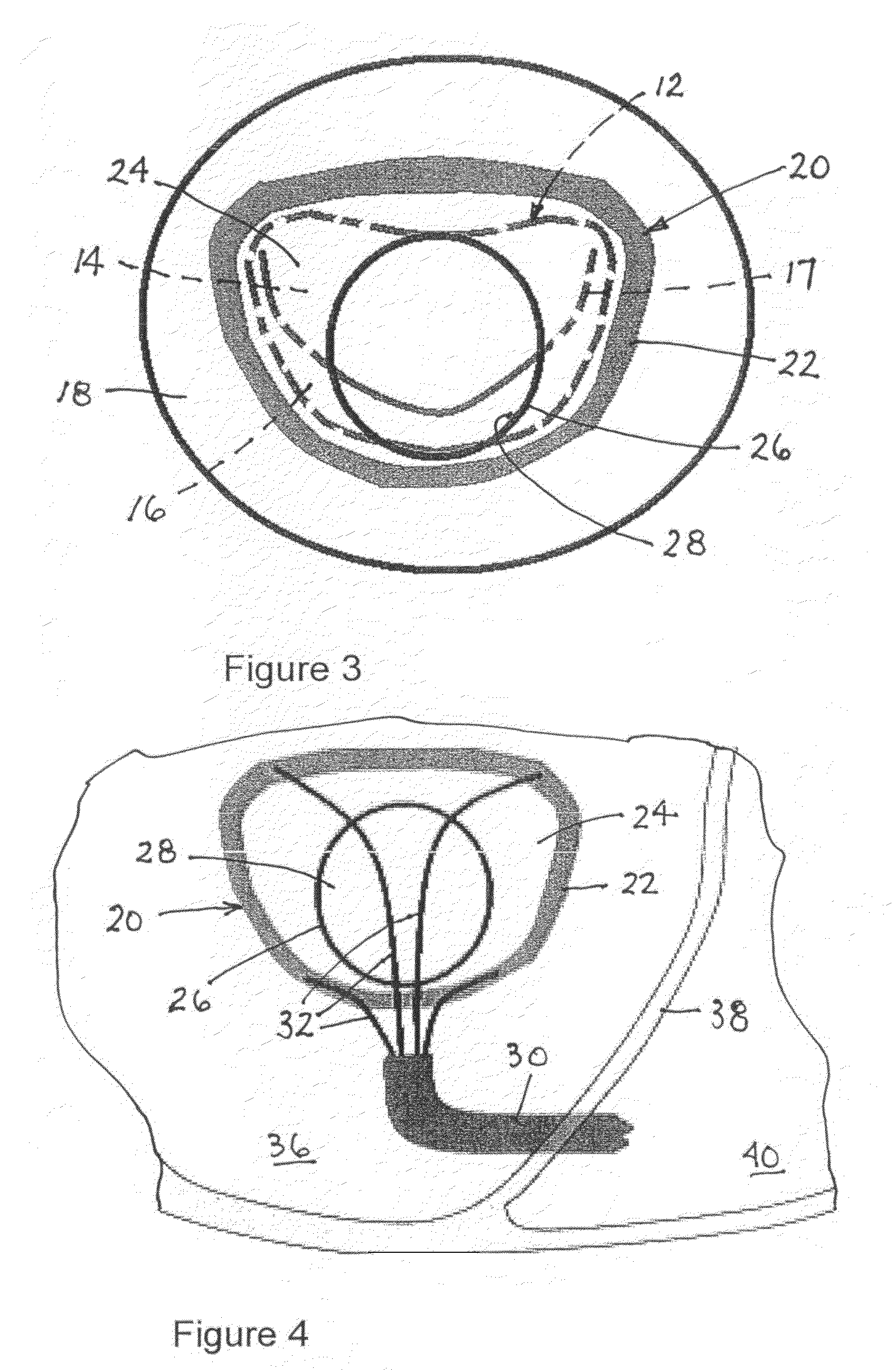 Implantable scaffolding containing an orifice for use with a prosthetic or bio-prosthetic valve