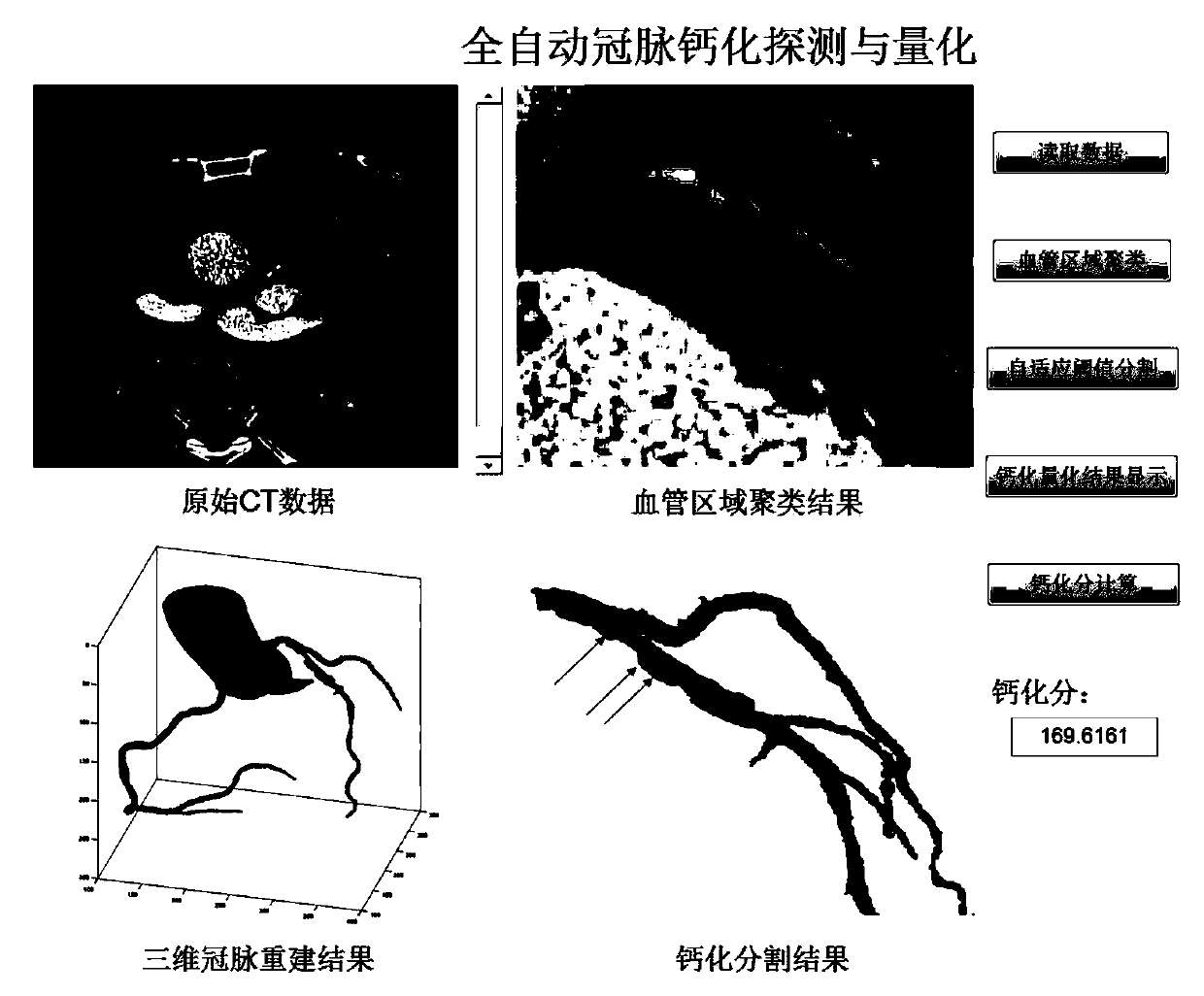 Device and method for detecting and quantifying coronary artery calcification in enhanced CT images