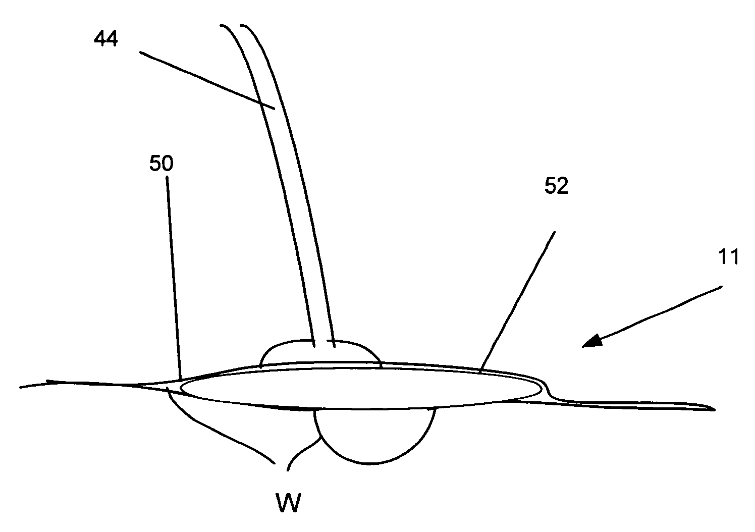 Method and device for providing intermittent negative pressure wound healing