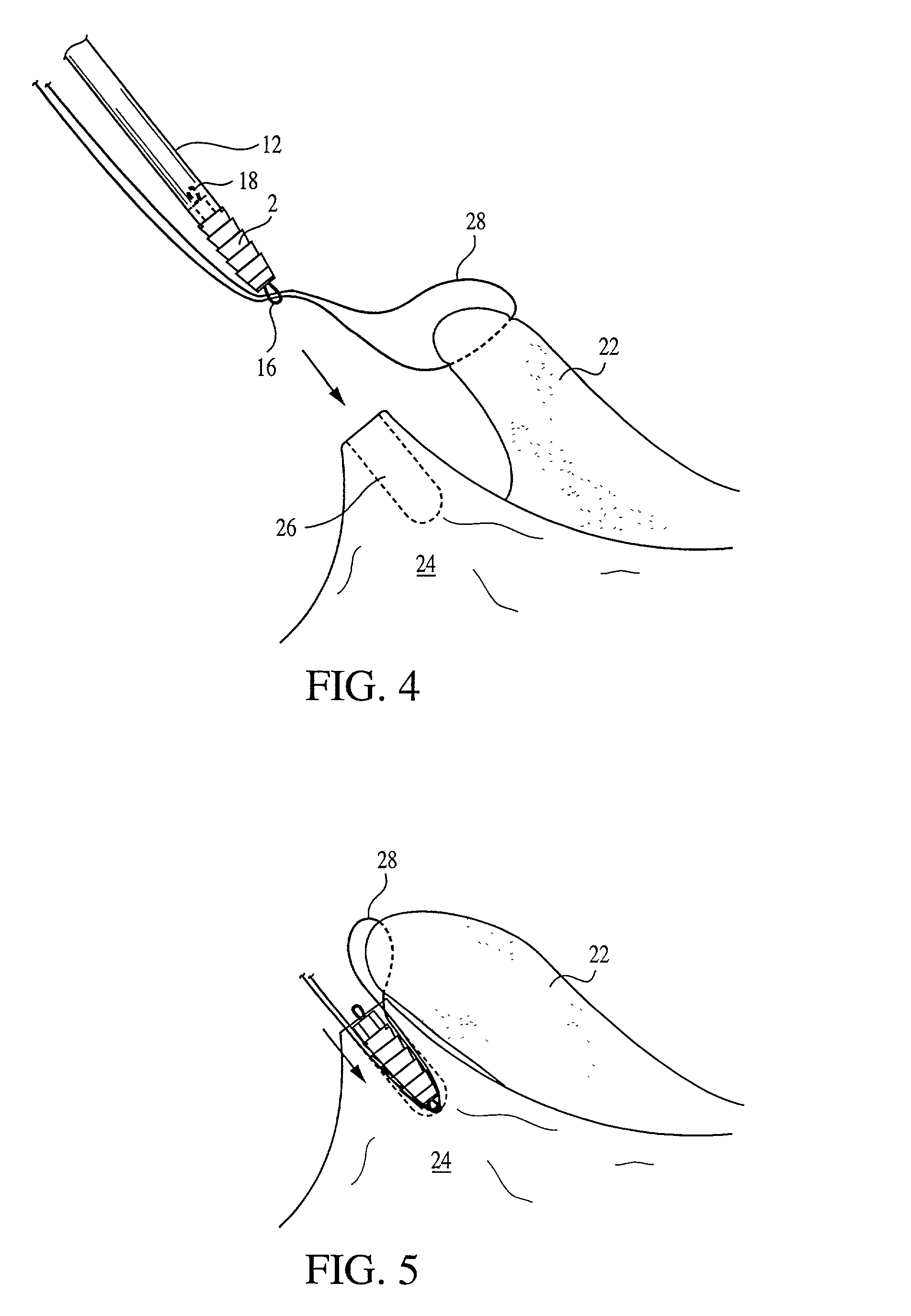 Interference fit knotless suture anchor fixation
