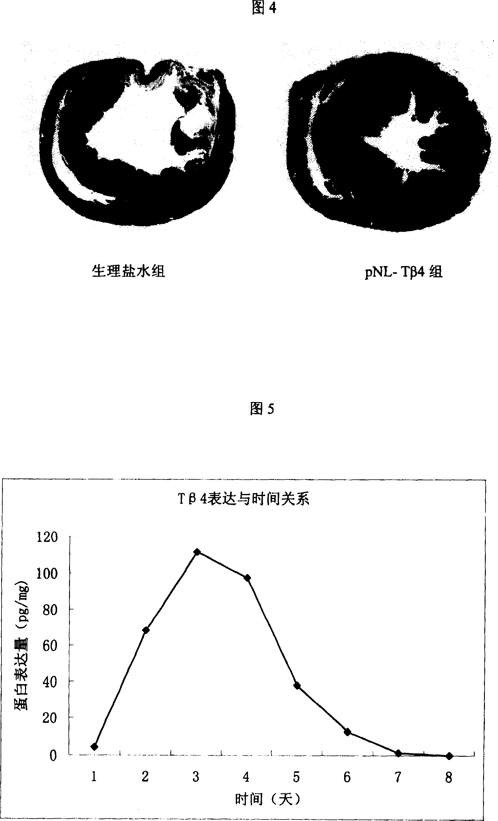 Recombinant plasmid with human thymosin Beta-4gene