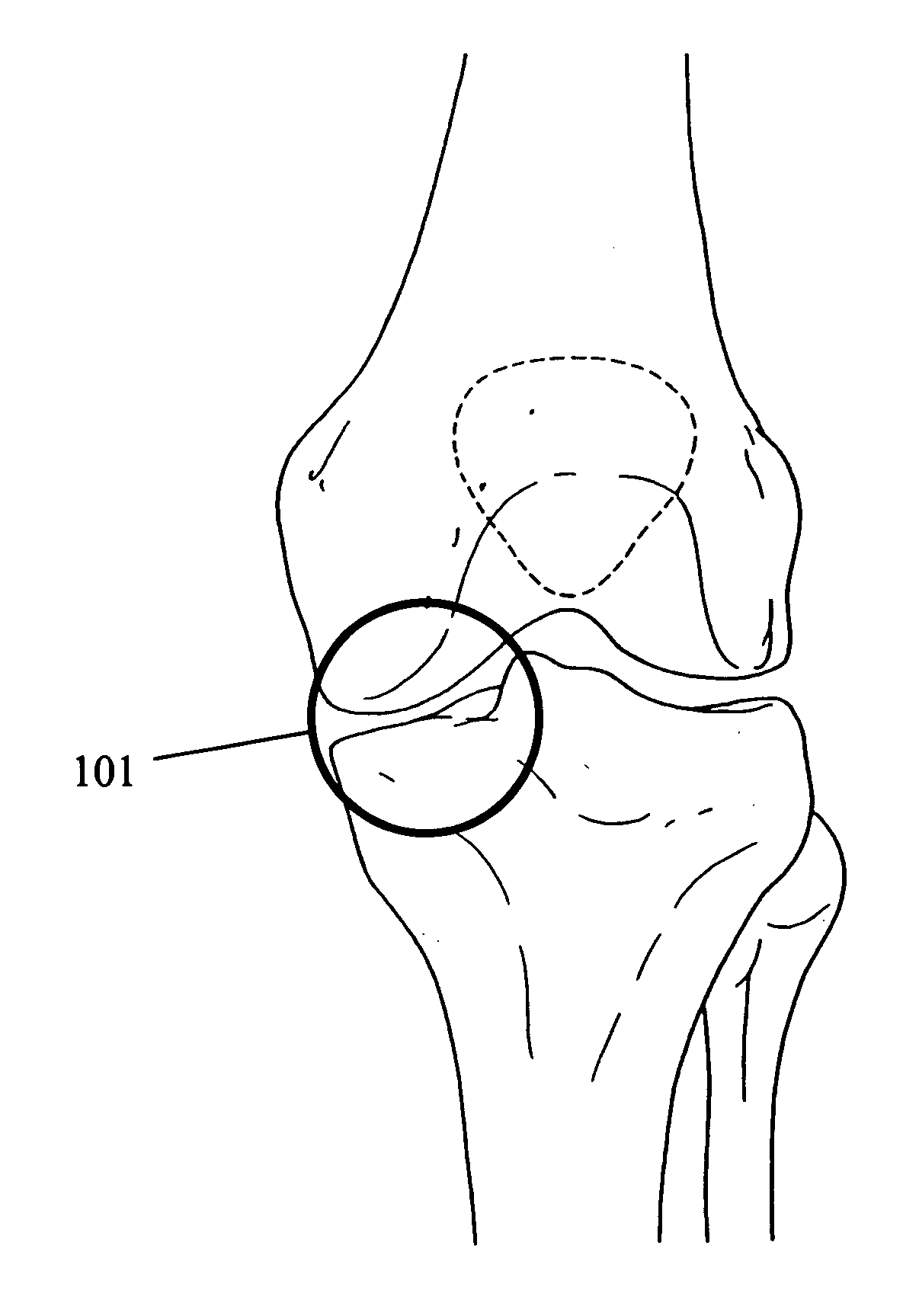 Bone treatment method with implants and instrumentation