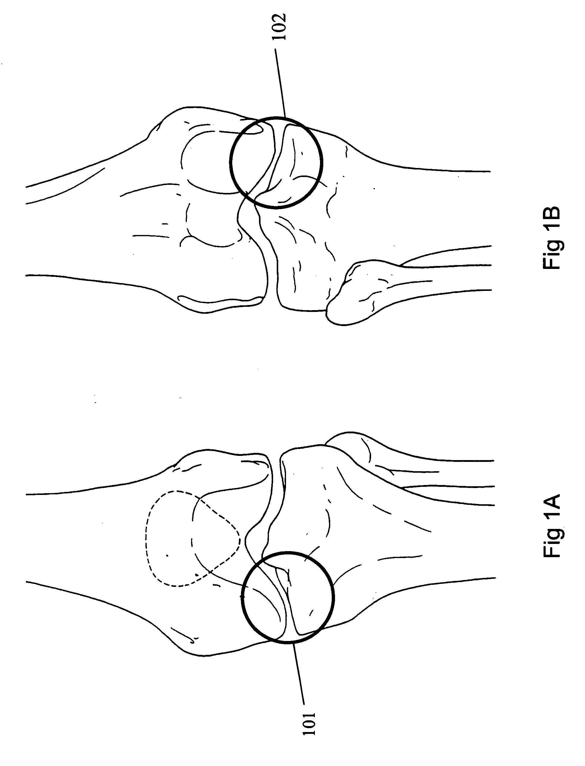 Bone treatment method with implants and instrumentation