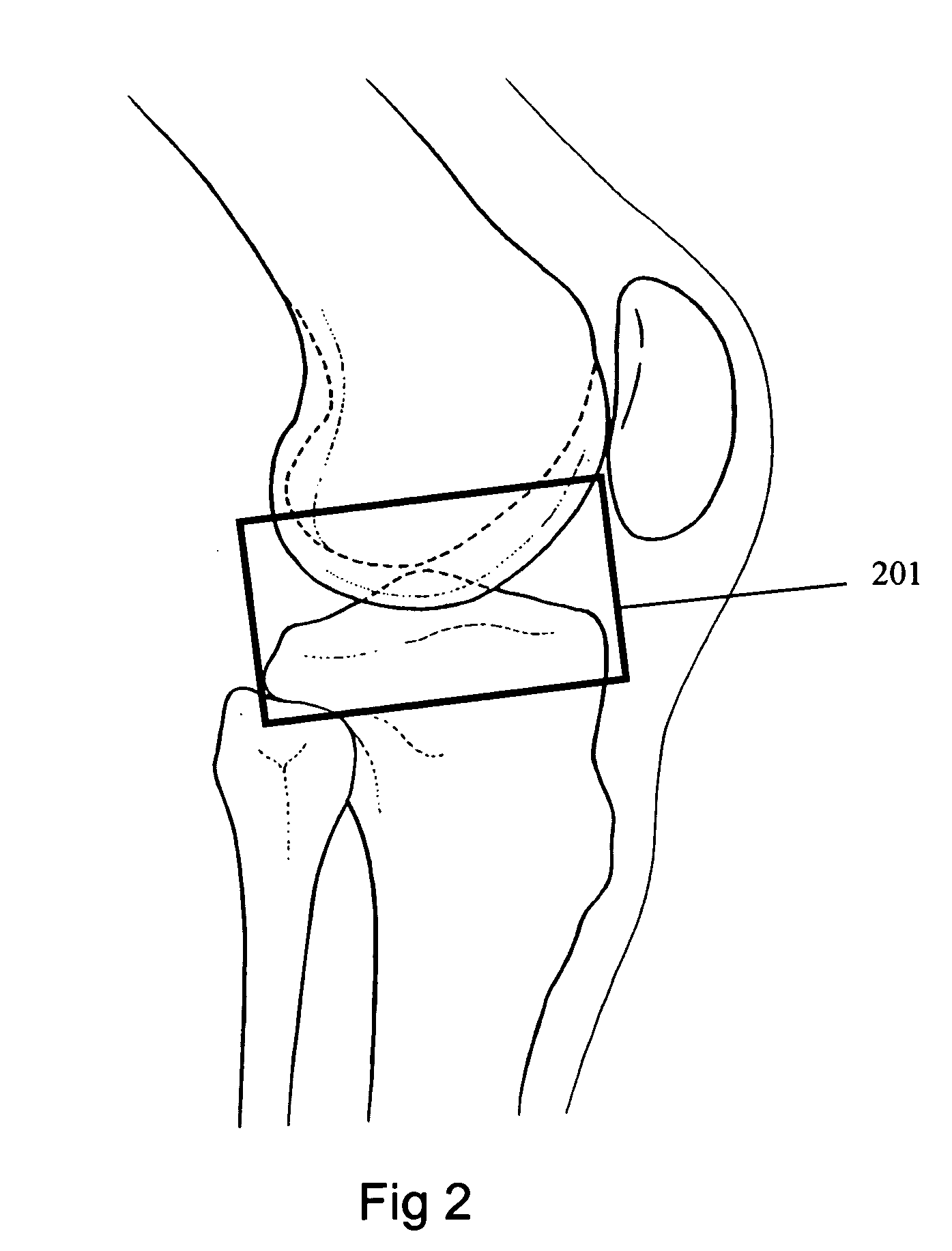 Bone treatment method with implants and instrumentation