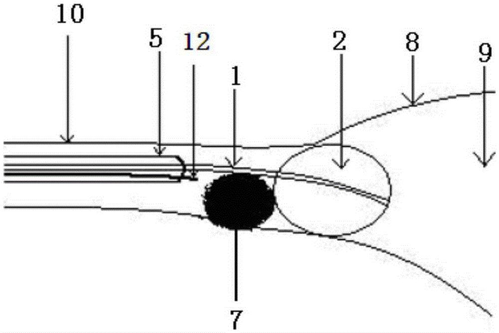 Ureteral stone movement plugging device