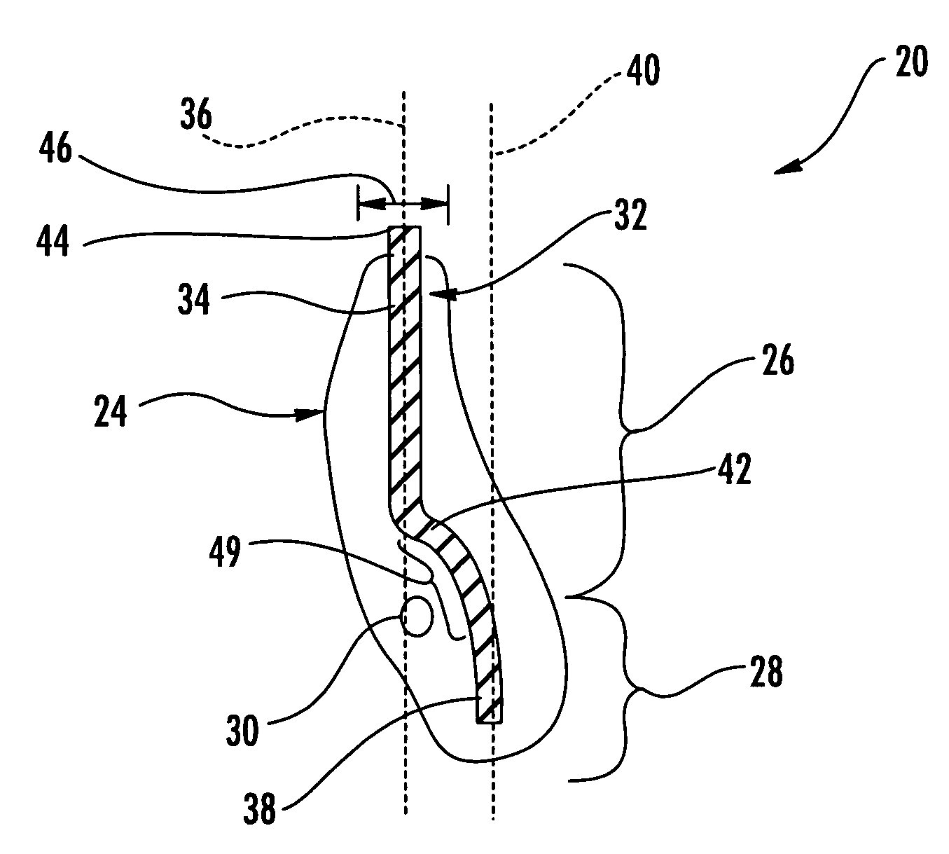 Dental fixture implantation system and associated method