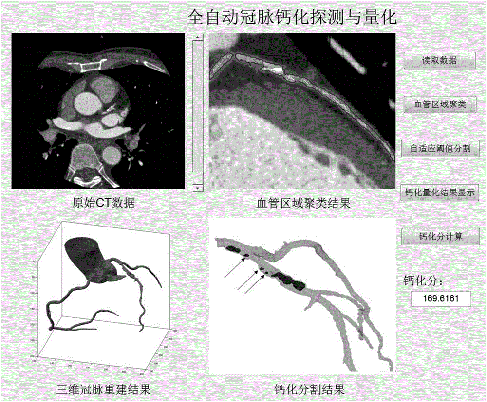 Device and method for coronary artery calcification detection and quantification in CTA image