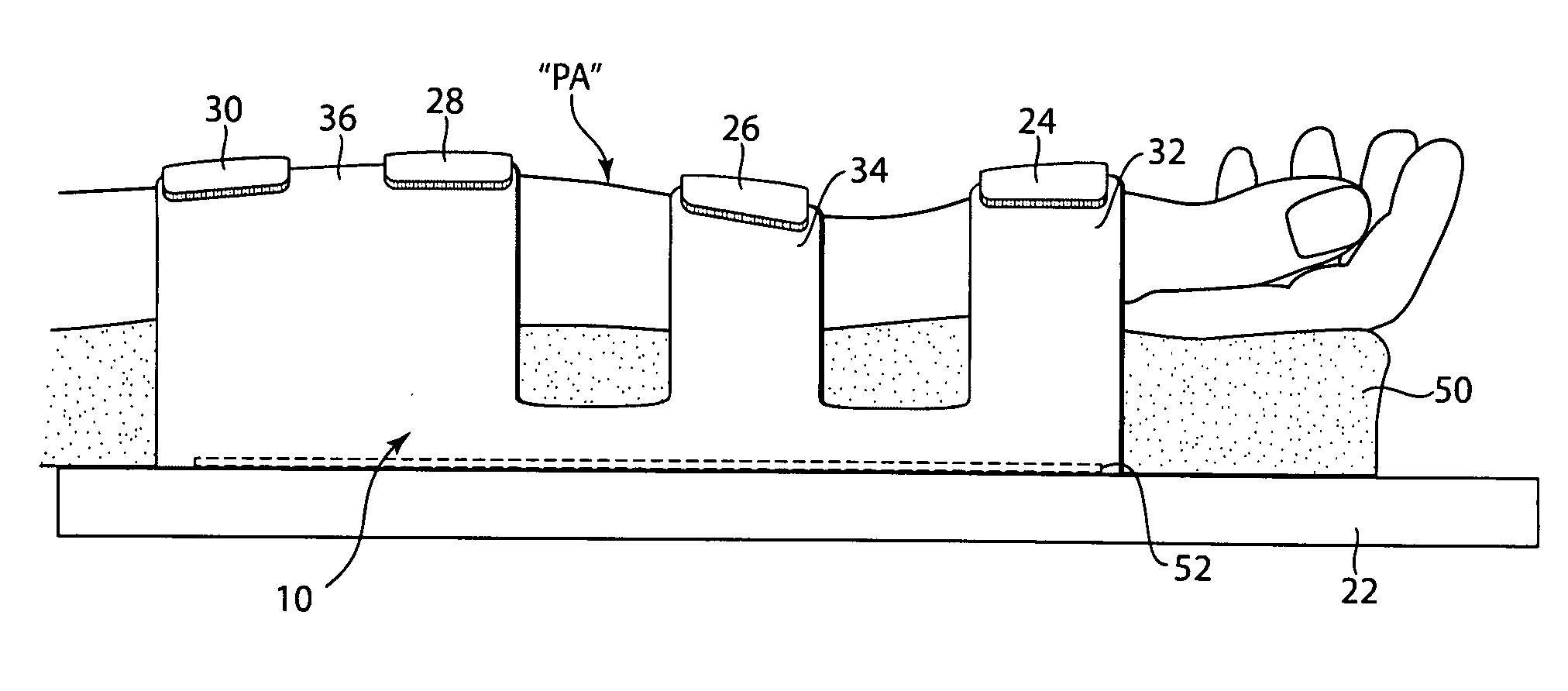 Arm board patient securement arrangement