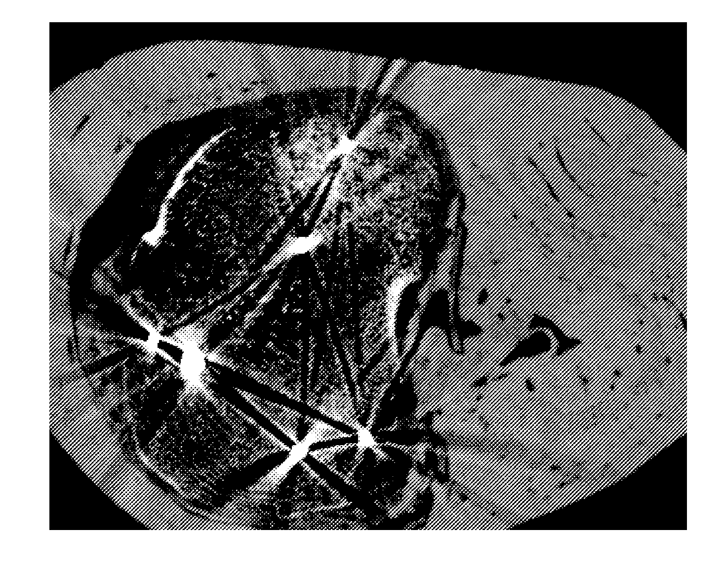 Metal artifacts reduction for cone beam ct