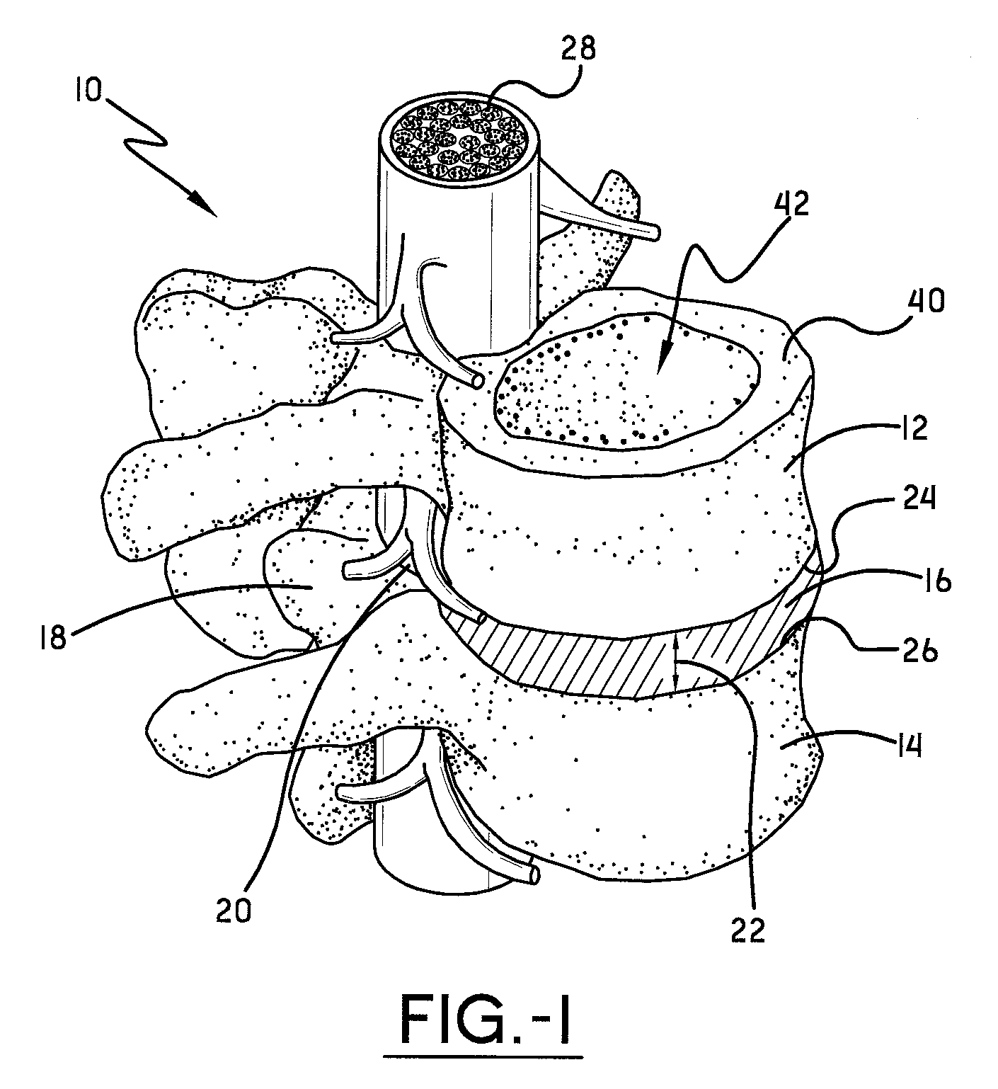 Spine surgery method and extractor