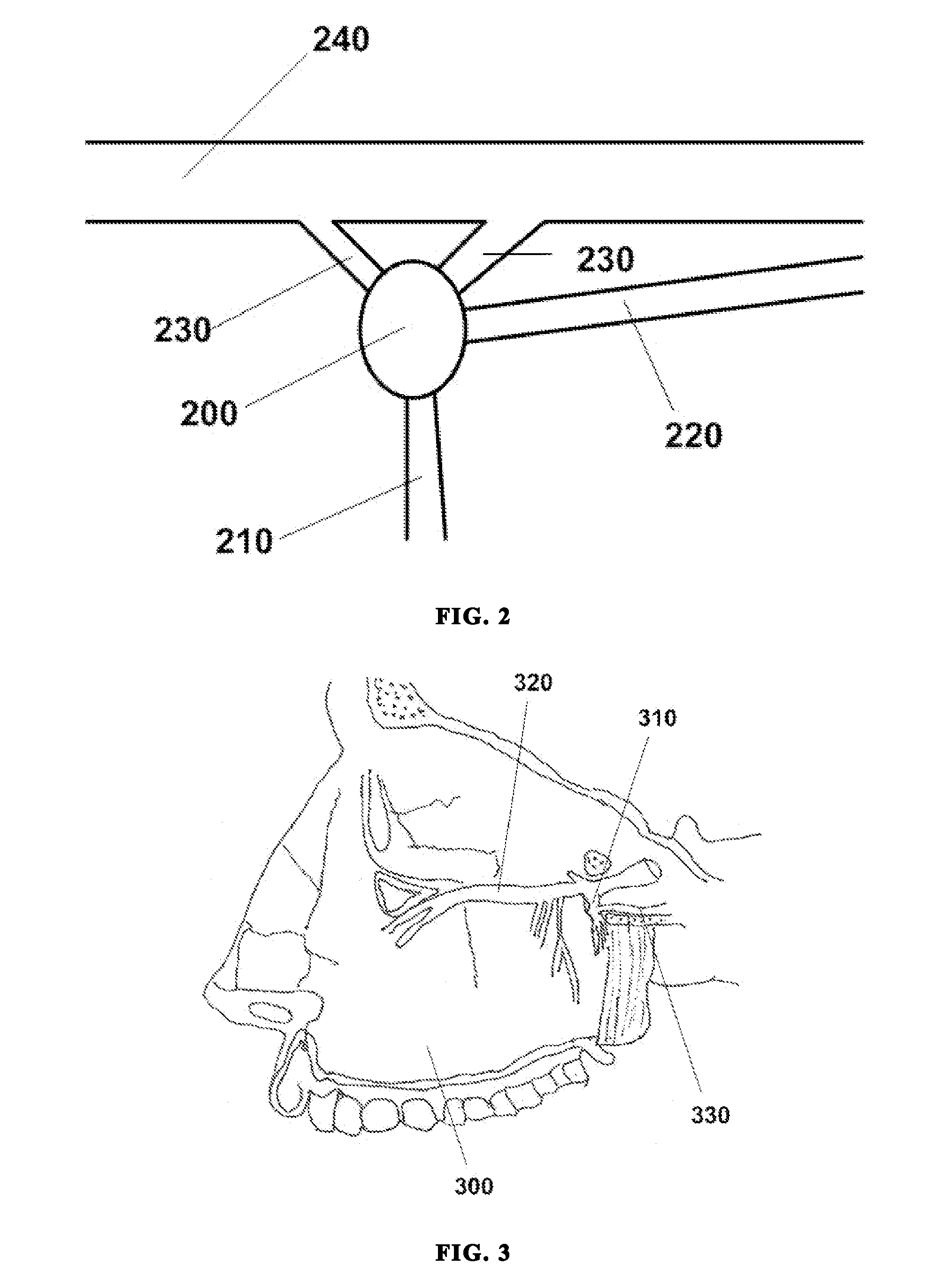 Ultrasound neuromodulation of the sphenopalatine ganglion