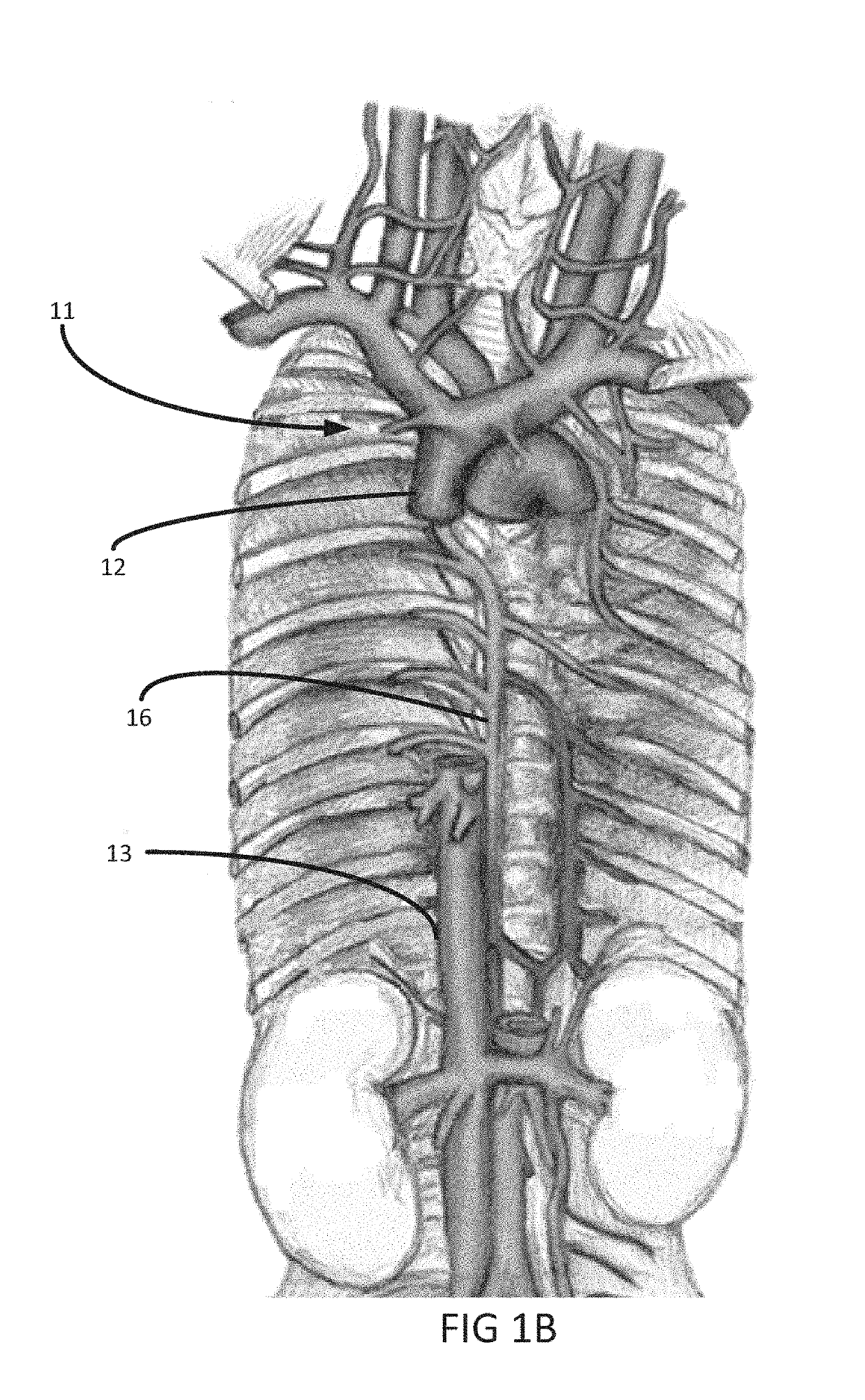 Systems and methods for selectively occluding the superior vena cava for treating heart conditions