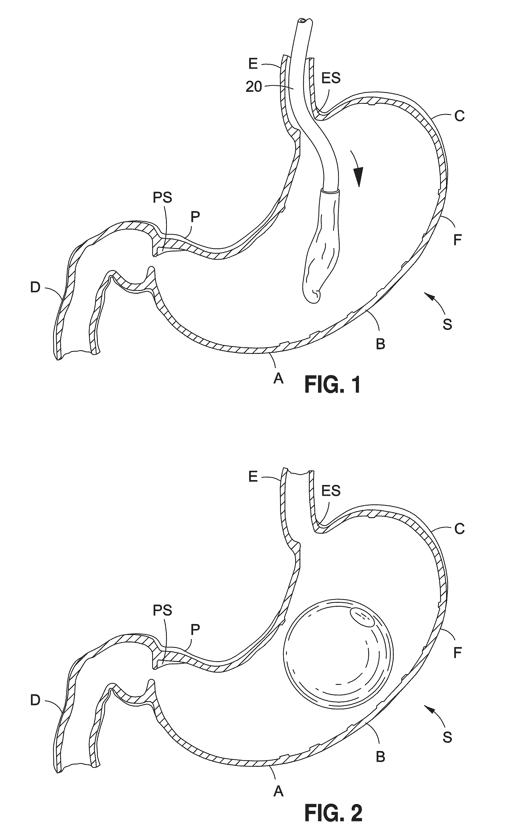 Intragastric balloon shell materials and construction