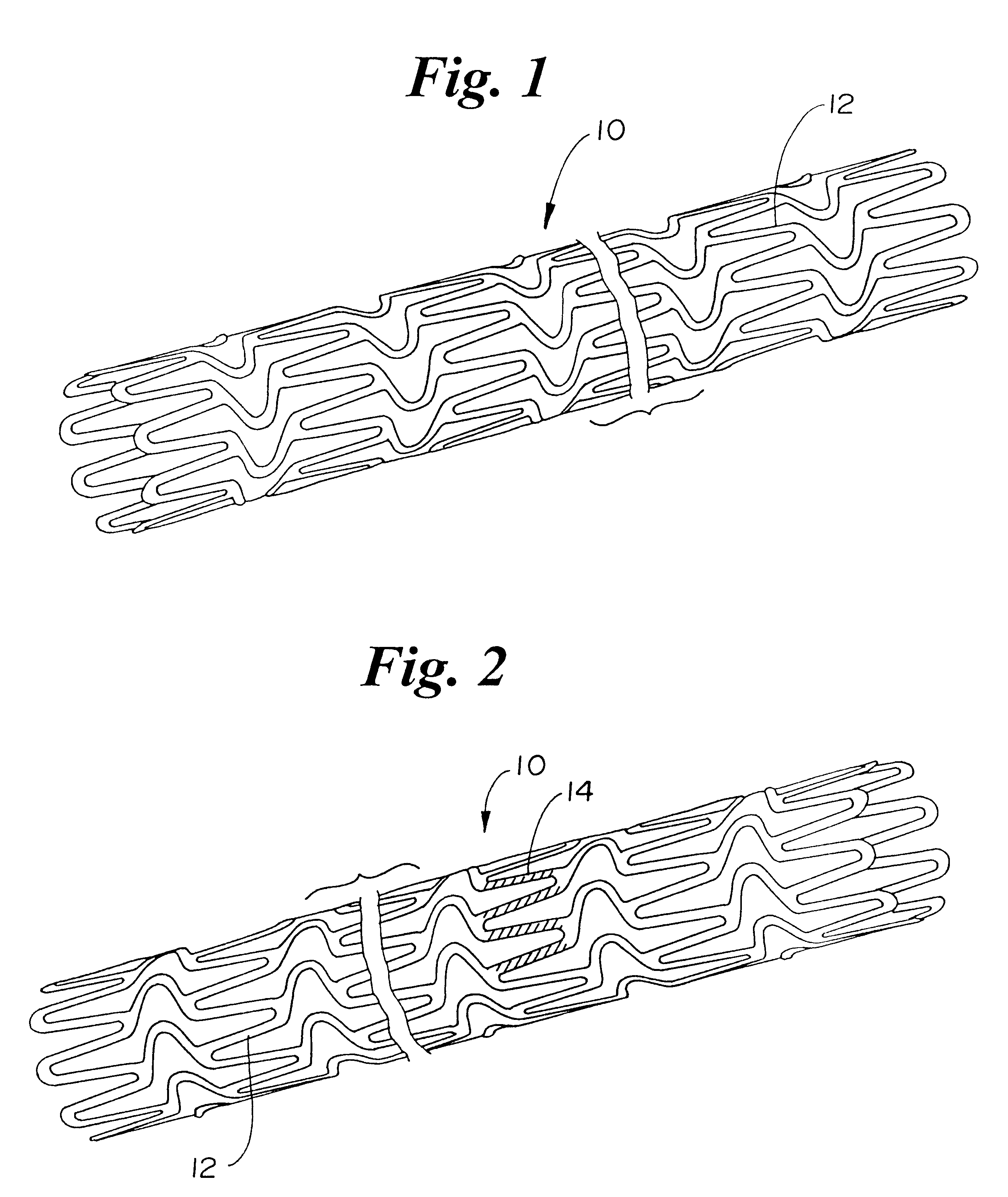 Magnetic stent