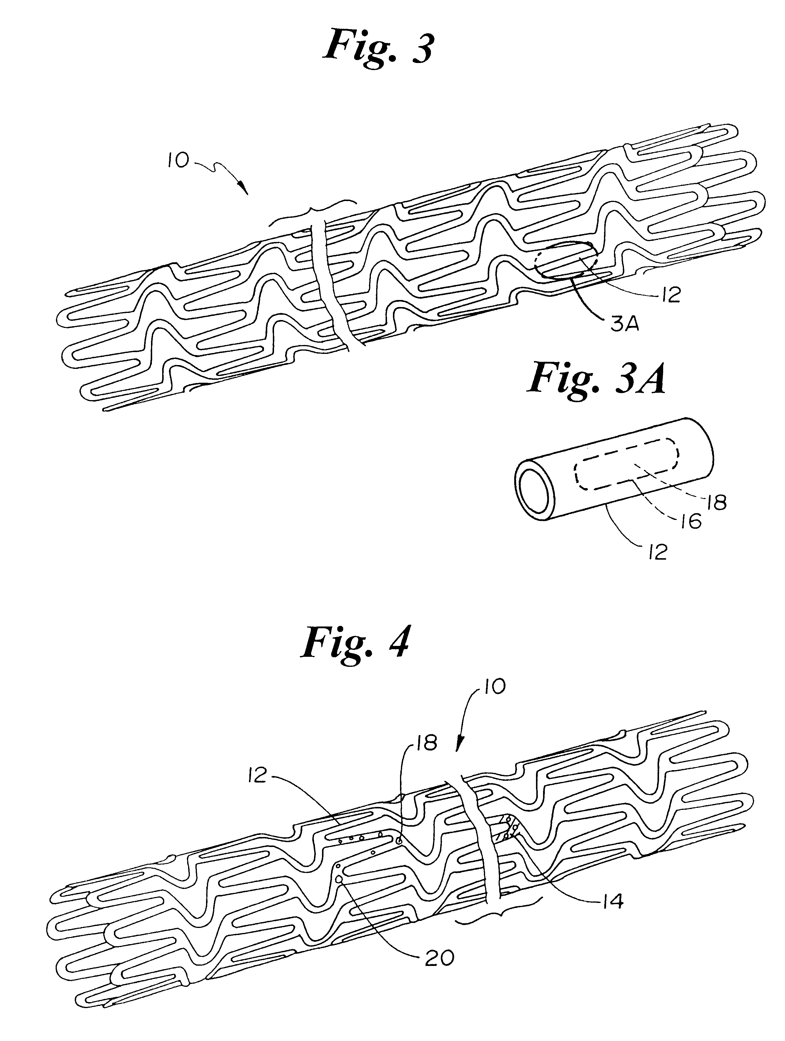 Magnetic stent