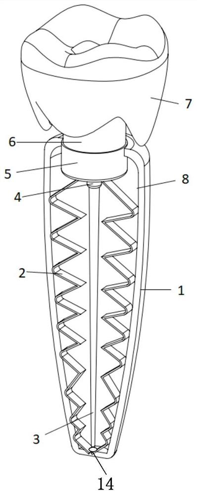 Oral implant device and implant method for avoiding secondary operation