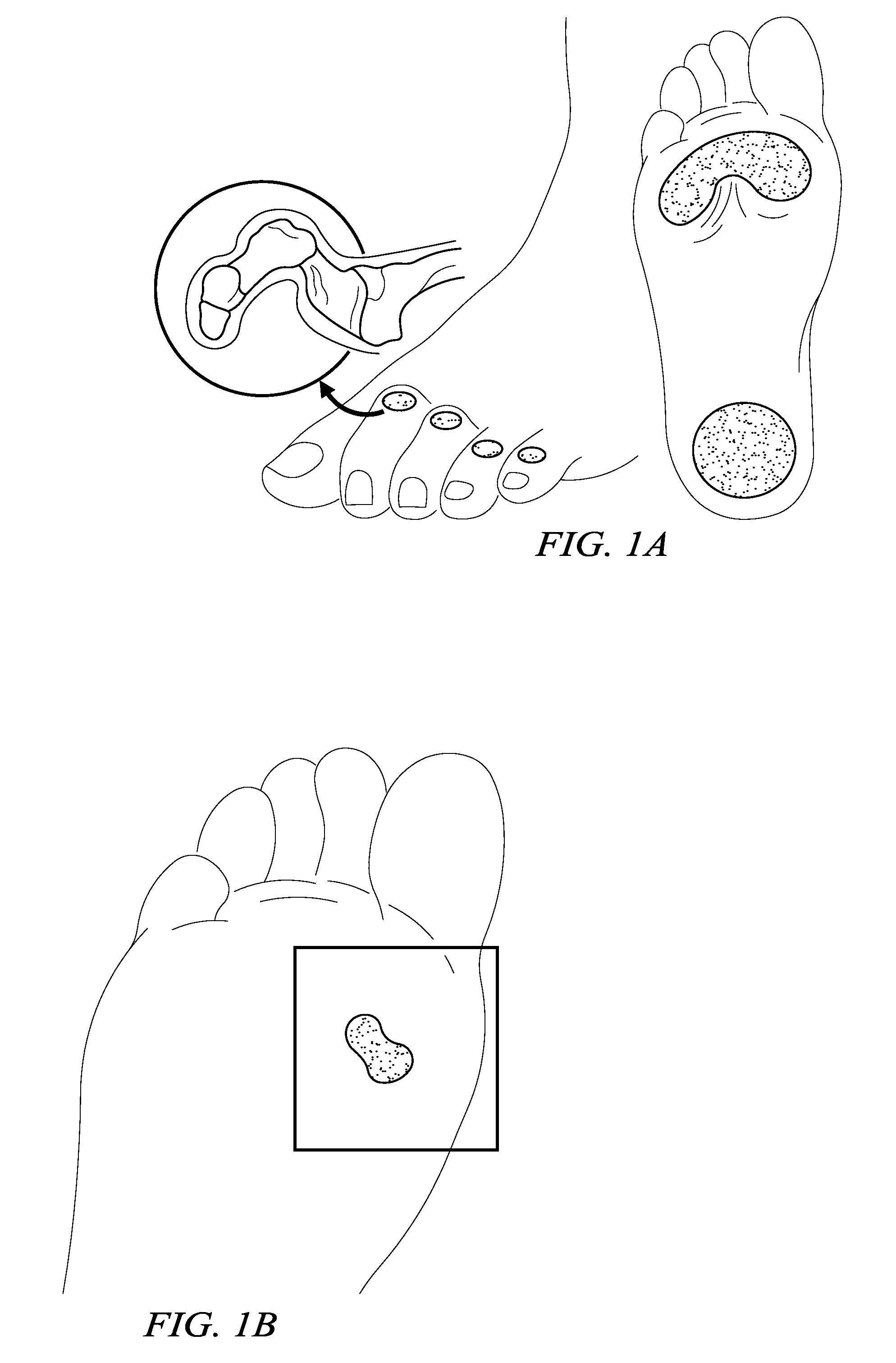 Electrosurgical system and method for sterilizing chronic wound tissue