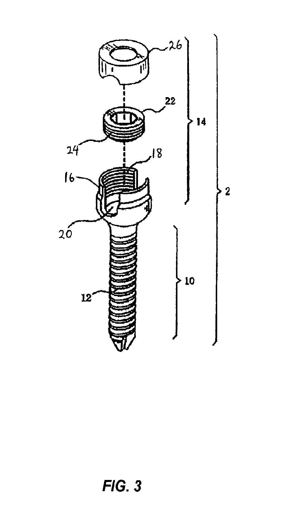 Spinal stabilization device