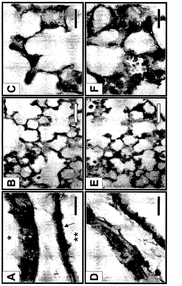 Use of TGF-BETA antagonists to treat infants at risk of developing bronchopulmonary dysplasia