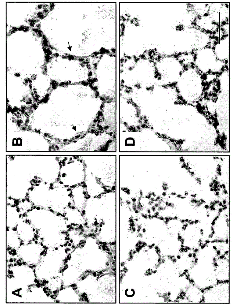 Use of TGF-BETA antagonists to treat infants at risk of developing bronchopulmonary dysplasia