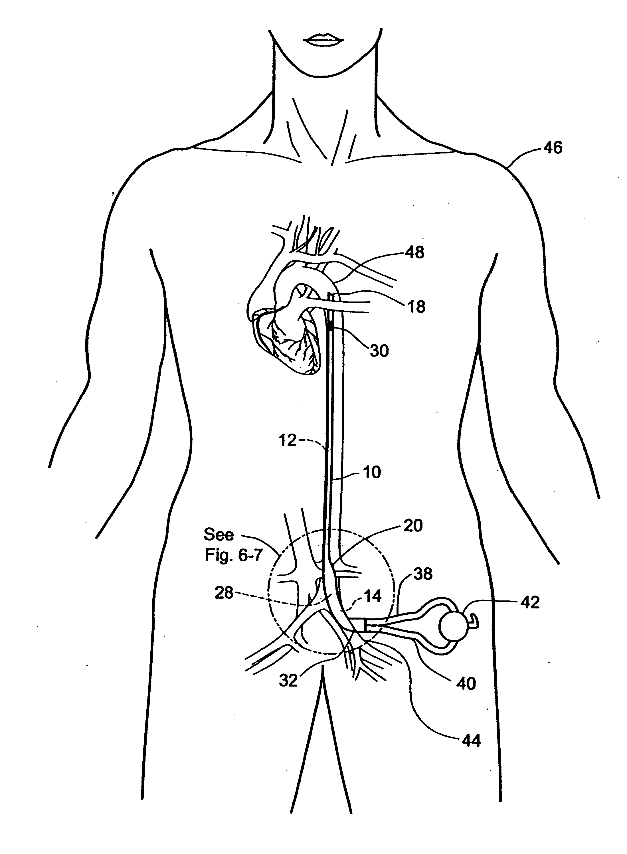 Multilumen catheter for minimizing limb ischemia