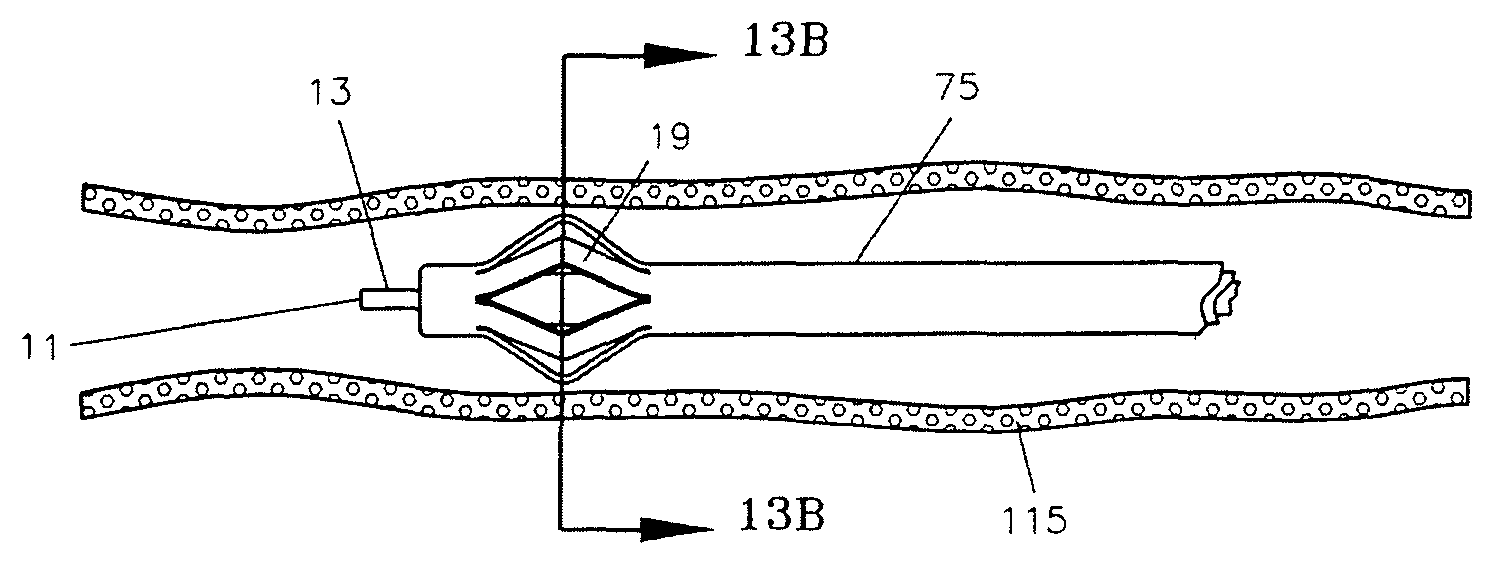 Endovascular treatment device having a fiber tip spacer