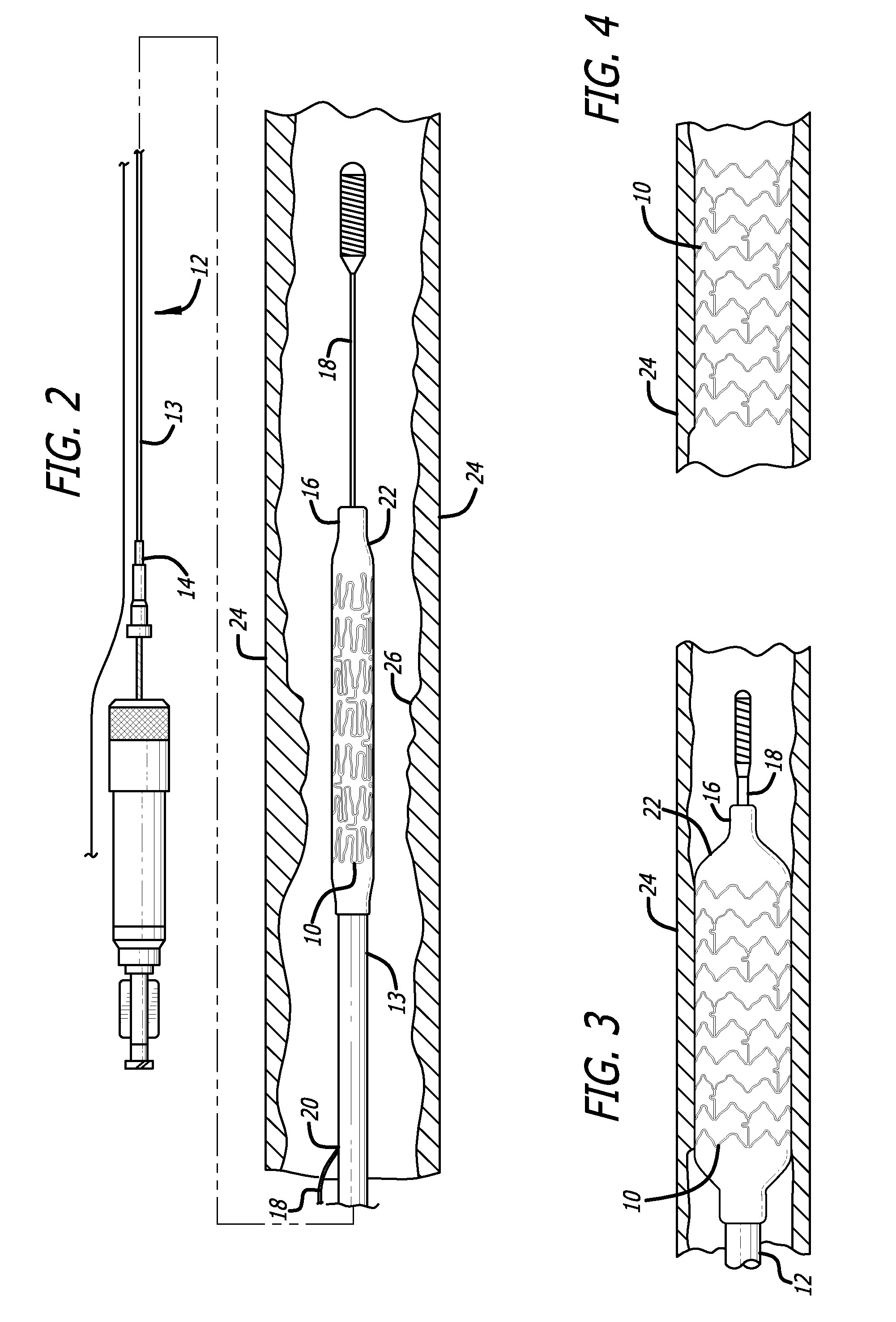 Stent having optimized expansion ratio