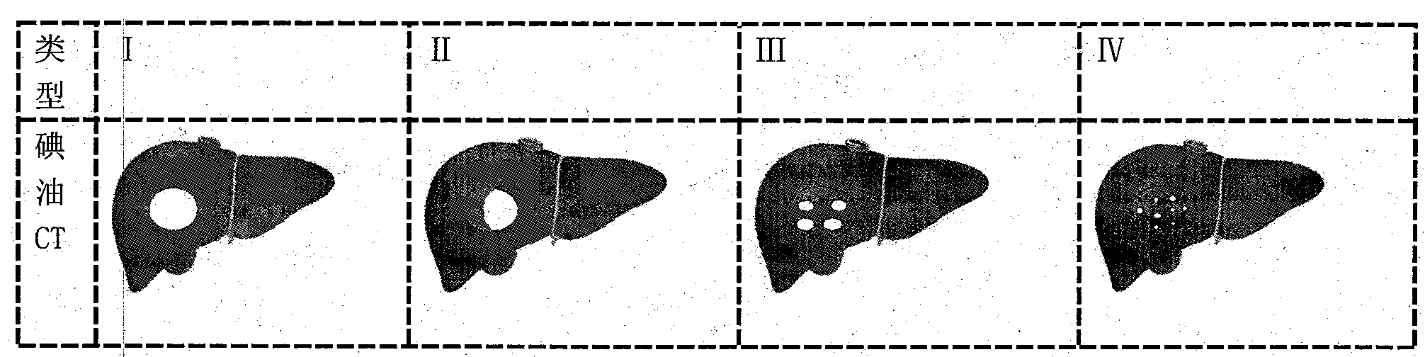 United autonomous respiration control on-line alignment technique using iodized oil image to guide image-guided radiotherapy