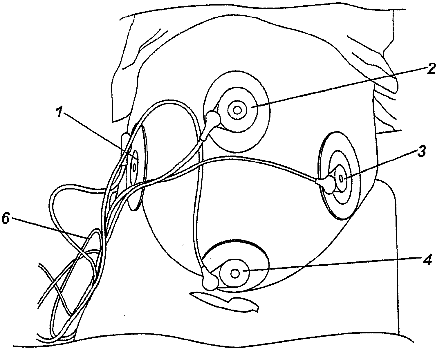 Electrode and electrode positioning arrangement for abdominal fetal electrocardiogram detection