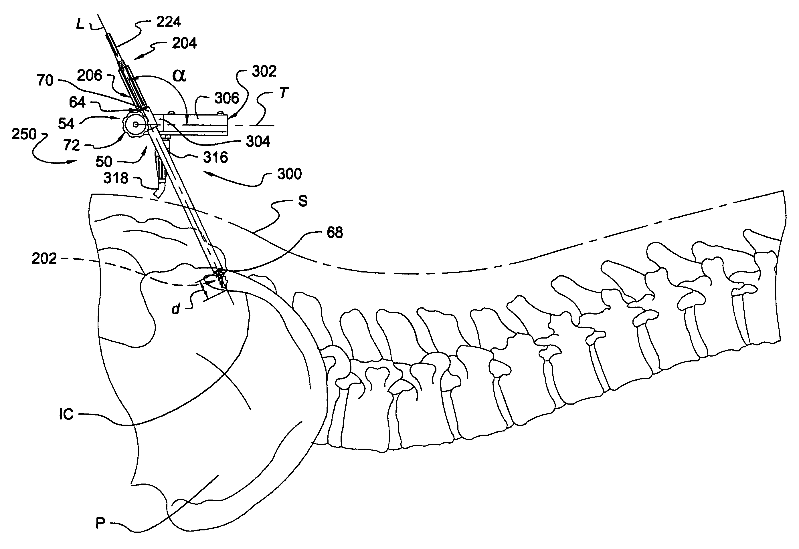 Instrumentation and method for mounting a surgical navigation reference device to a patient