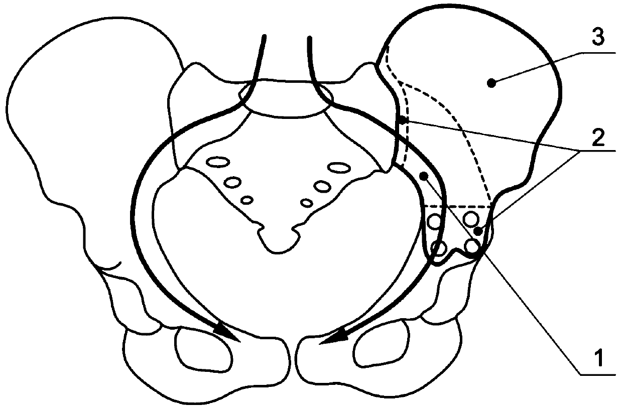 Fiber-reinforced 3D printed polymer pelvis substitute