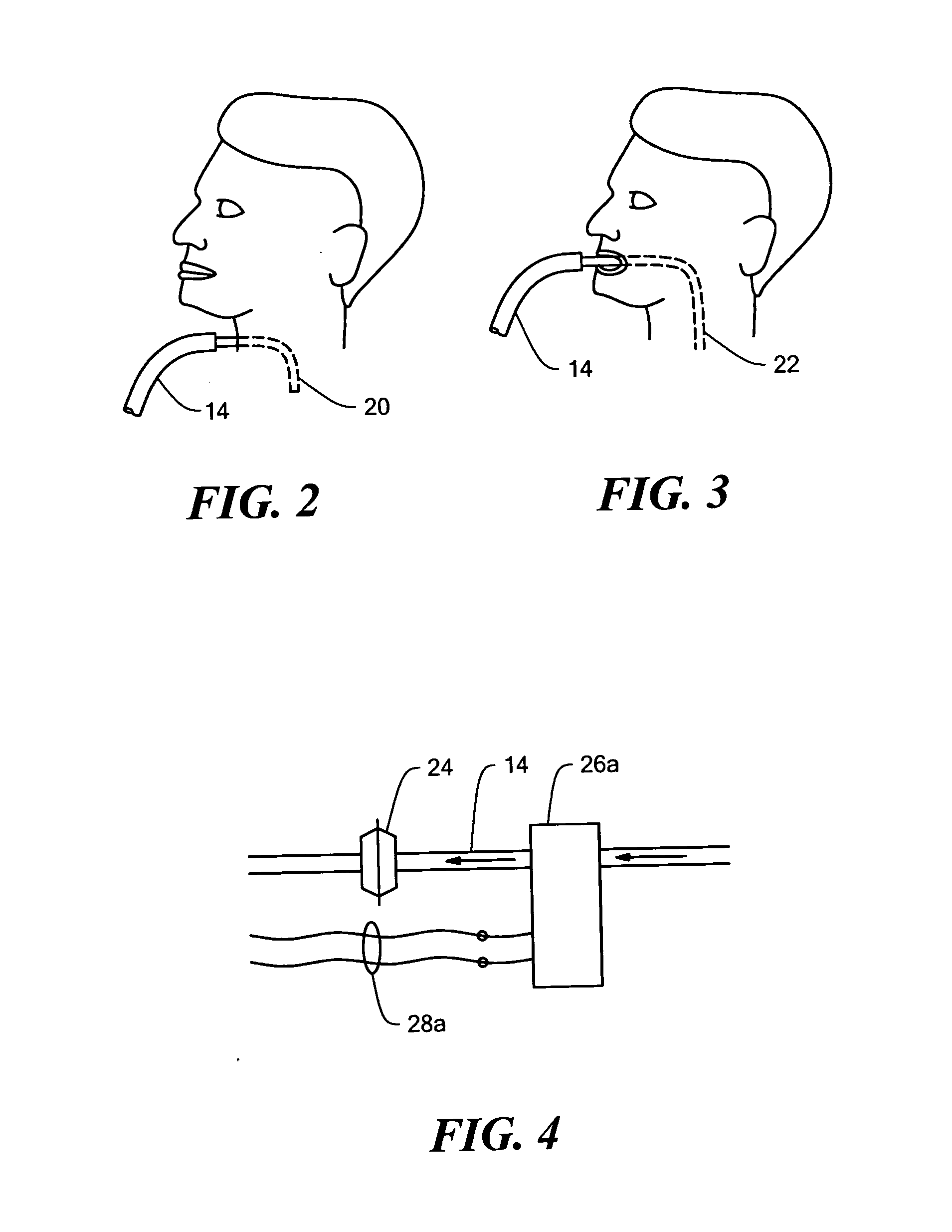 Insufflation-exsufflation system for removal of broncho-pulmonary secretions with automatic triggering of inhalation phase