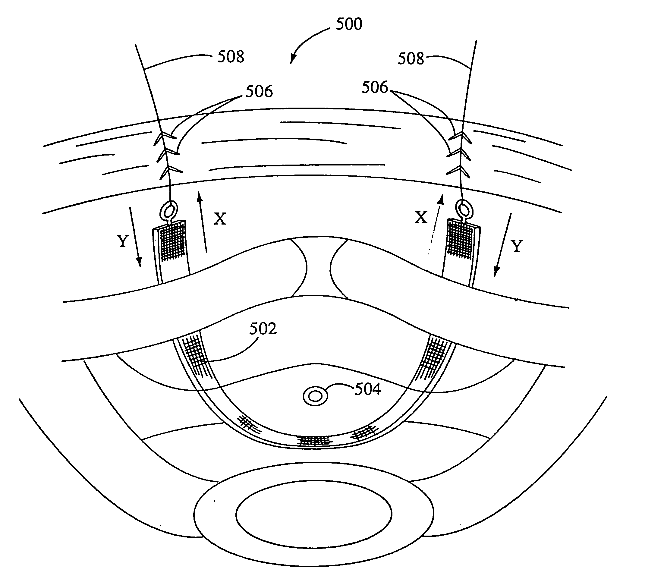 System and method for securing implants to soft tissue