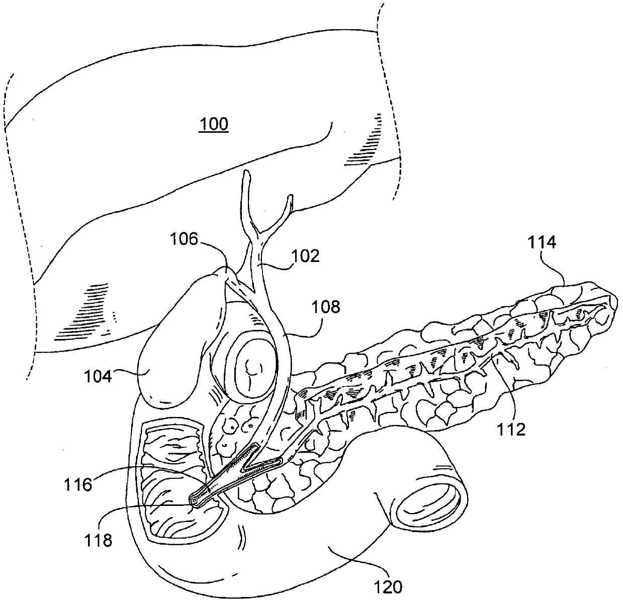 Endoscopic ultrasound-guided biliary access system