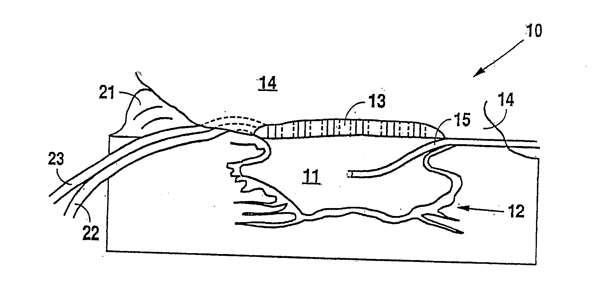 Negative pressure treatment system with heating and cooling provision