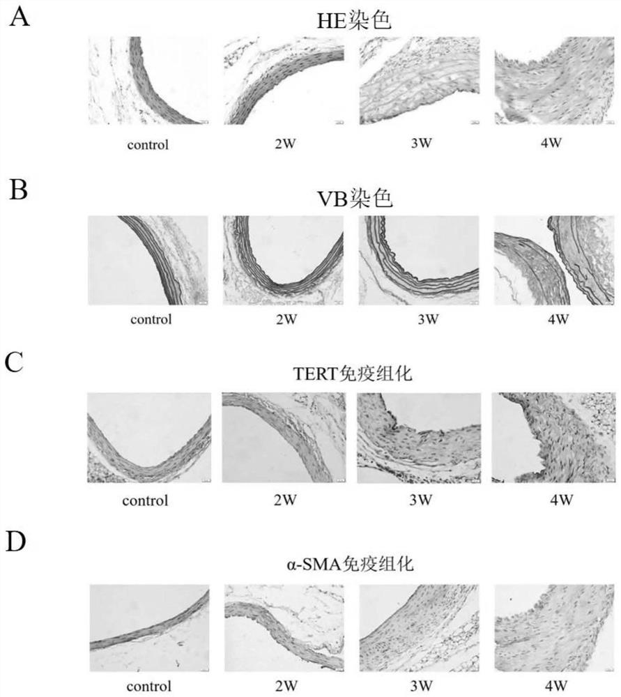 Application of reagent for inhibiting TERT expression in preparation of medicine for preventing or treating thoracic aortic aneurysm