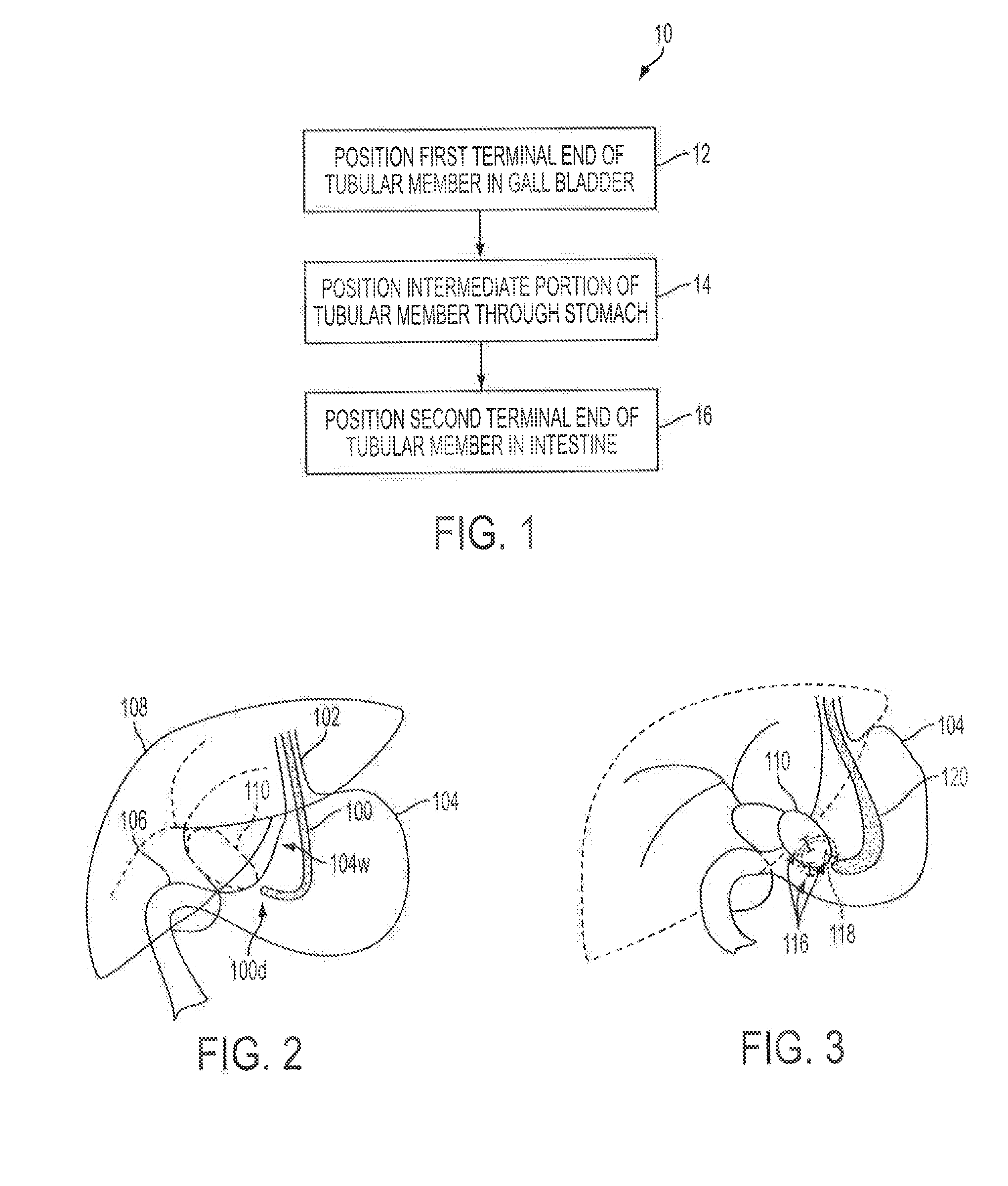 Methods for biliary diversion