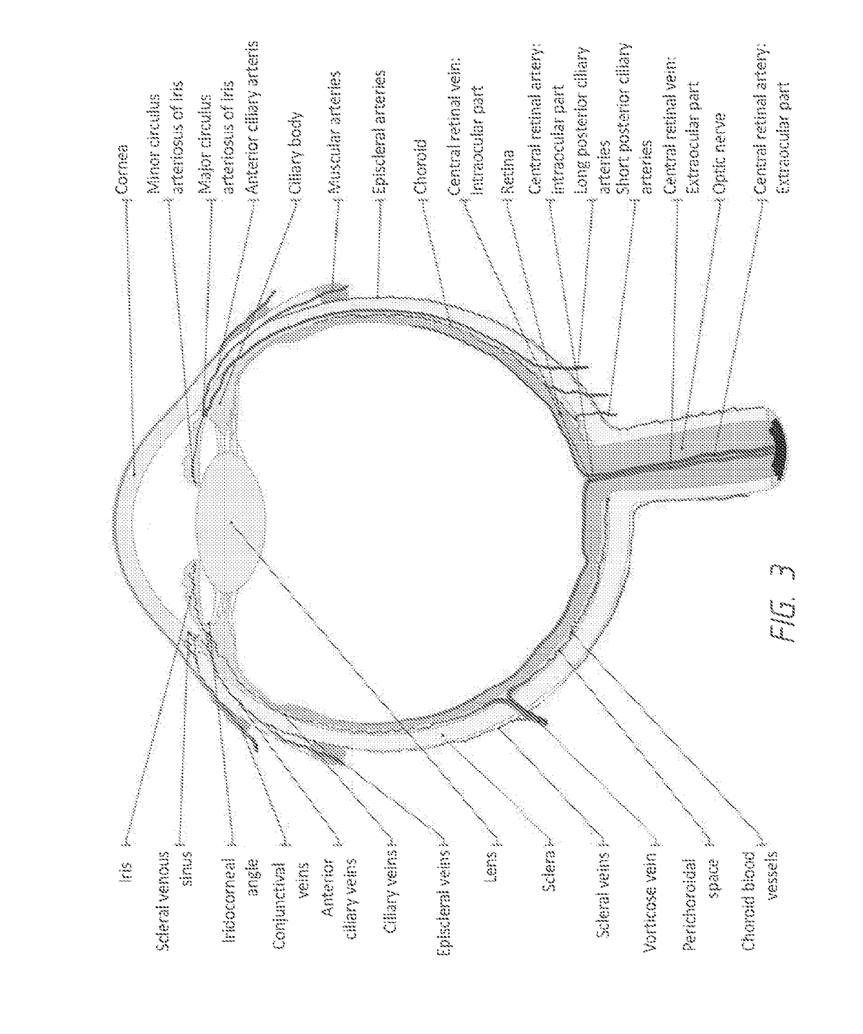 Shunt for Vascular Flow Enhancement