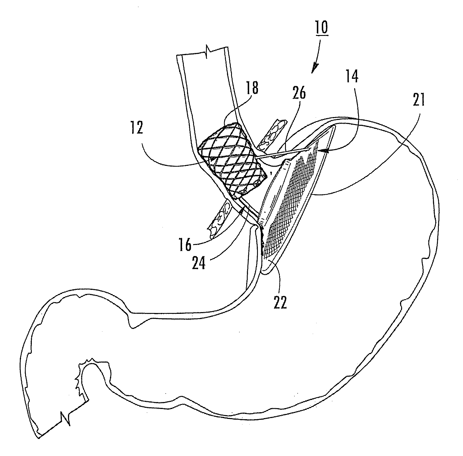 Bariatric device and method